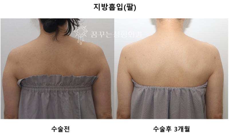 강남역 다이어트 지방흡입 이중턱, 승모근, 종아리보톡스 사진 3