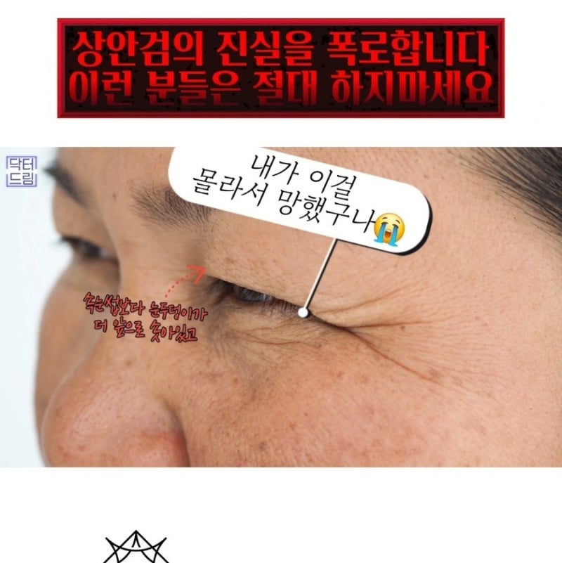 속시원한 중년쌍꺼풀의 진실, 이걸몰라서 제친구가 망했군요