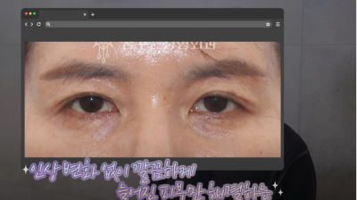 속시원한 중년쌍꺼풀의 진실, 이걸몰라서 제친구가 망했군요