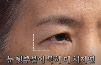 속시원한 중년쌍꺼풀의 진실, 이걸몰라서 제친구가 망했군요 사진 17