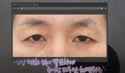 속시원한 중년쌍꺼풀의 진실, 이걸몰라서 제친구가 망했군요 사진 22