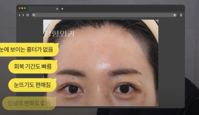 속시원한 중년쌍꺼풀의 진실, 이걸몰라서 제친구가 망했군요 사진 15