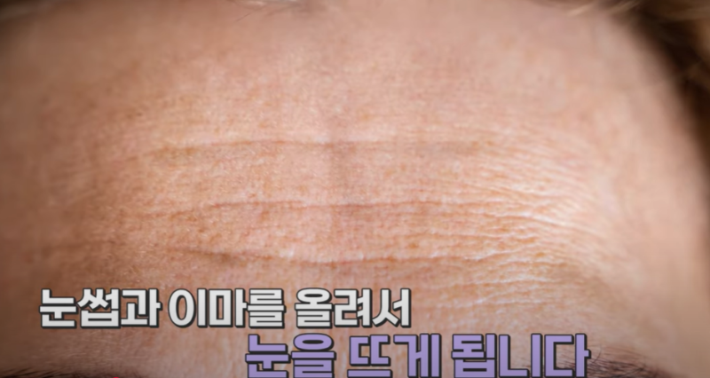 속시원한 중년쌍꺼풀의 진실, 이걸몰라서 제친구가 망했군요 사진 6