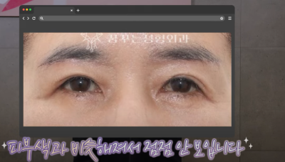 속시원한 중년쌍꺼풀의 진실, 이걸몰라서 제친구가 망했군요 사진 25
