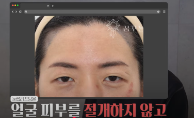 속시원한 중년쌍꺼풀의 진실, 이걸몰라서 제친구가 망했군요 사진 14