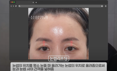 속시원한 중년쌍꺼풀의 진실, 이걸몰라서 제친구가 망했군요 사진 11