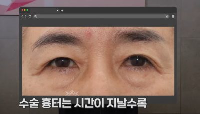 속시원한 중년쌍꺼풀의 진실, 이걸몰라서 제친구가 망했군요 사진 24