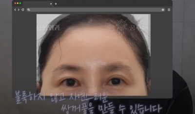 속시원한 중년쌍꺼풀의 진실, 이걸몰라서 제친구가 망했군요 사진 13