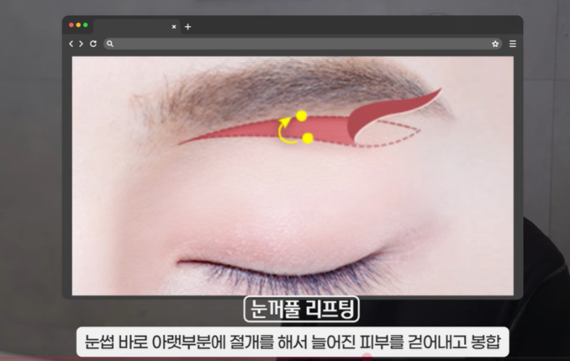 속시원한 중년쌍꺼풀의 진실, 이걸몰라서 제친구가 망했군요 사진 20
