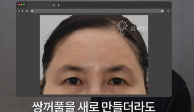 속시원한 중년쌍꺼풀의 진실, 이걸몰라서 제친구가 망했군요 사진 12