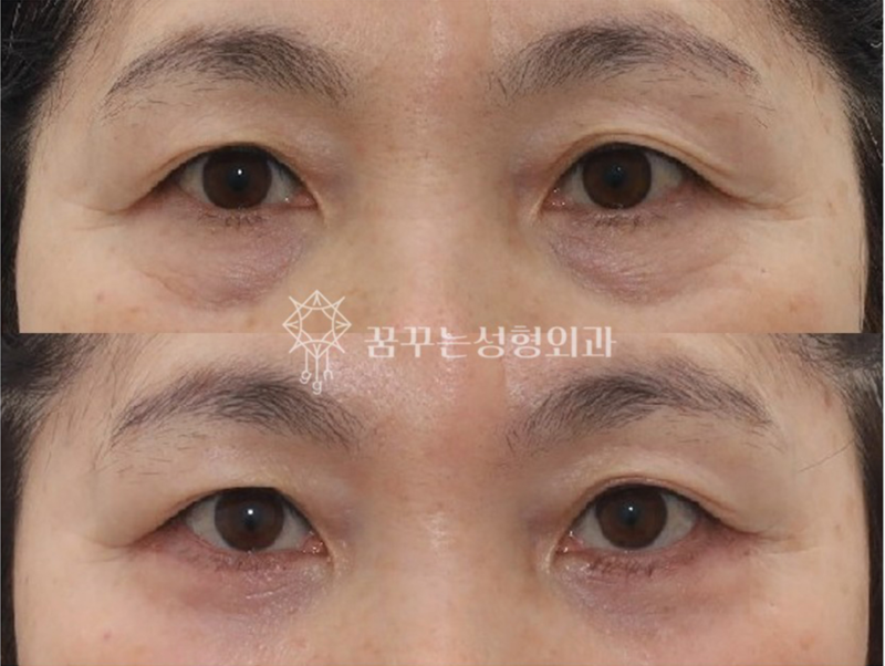 강남역 중년성형에도 트렌드가 있다. 사진 10