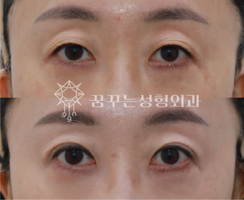 강남역 중년성형에도 트렌드가 있다. 사진 9