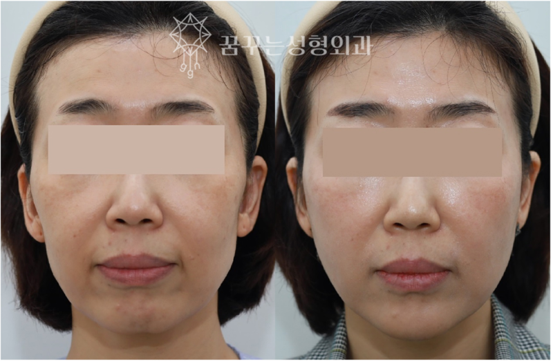 강남역 중년성형에도 트렌드가 있다. 사진 13