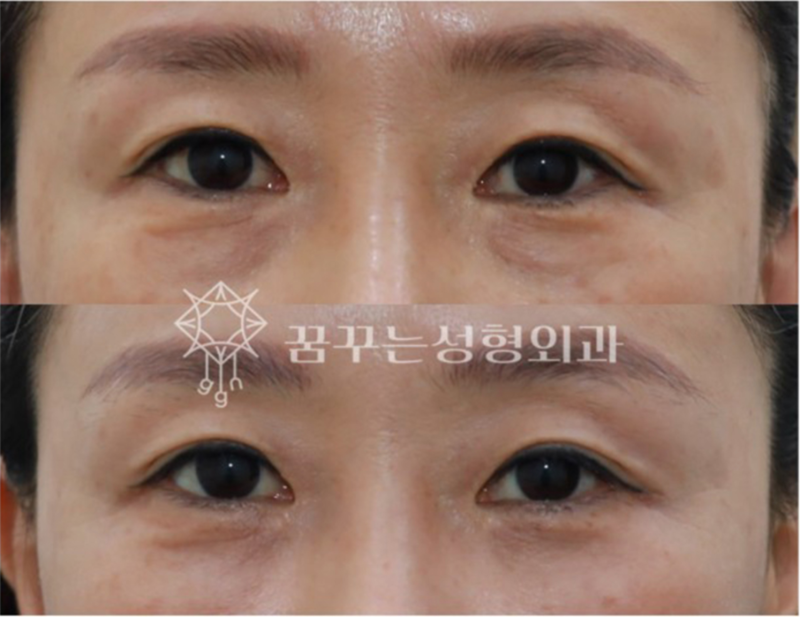 강남역 중년성형에도 트렌드가 있다. 사진 12