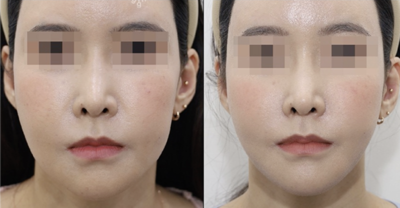 강남 실리프팅으로 짧은 중안면 만들기! 요즘 동안 성형의 핵심💡 사진 10