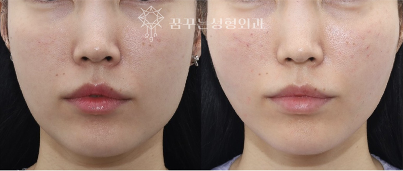 강남 실리프팅으로 짧은 중안면 만들기! 요즘 동안 성형의 핵심💡 사진 5