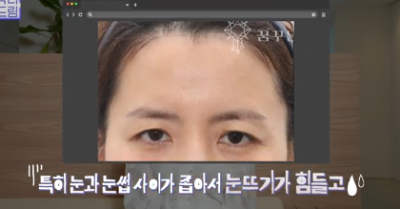 이마거상받고 3년지났는데...이거 어떡하죠? 원장아내가 받은 이마거상 후기 사진 12