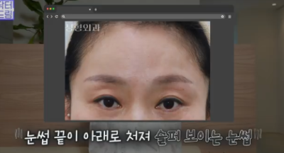 이마거상받고 3년지났는데...이거 어떡하죠? 원장아내가 받은 이마거상 후기 사진 17