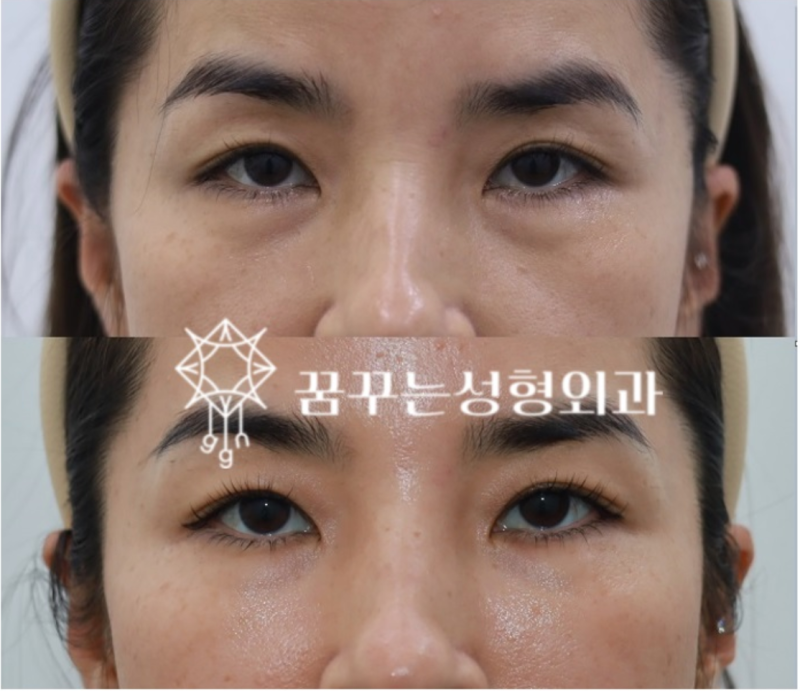 강남역 필러 후기, 아무데서나 하면 큰일 납니다. – 필러 전문 의학석사에게 받으세요! 사진 18