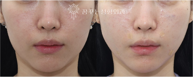 강남역 이마거상 잘하는 병원? 챗GPT에게 물어봤다 사진 14
