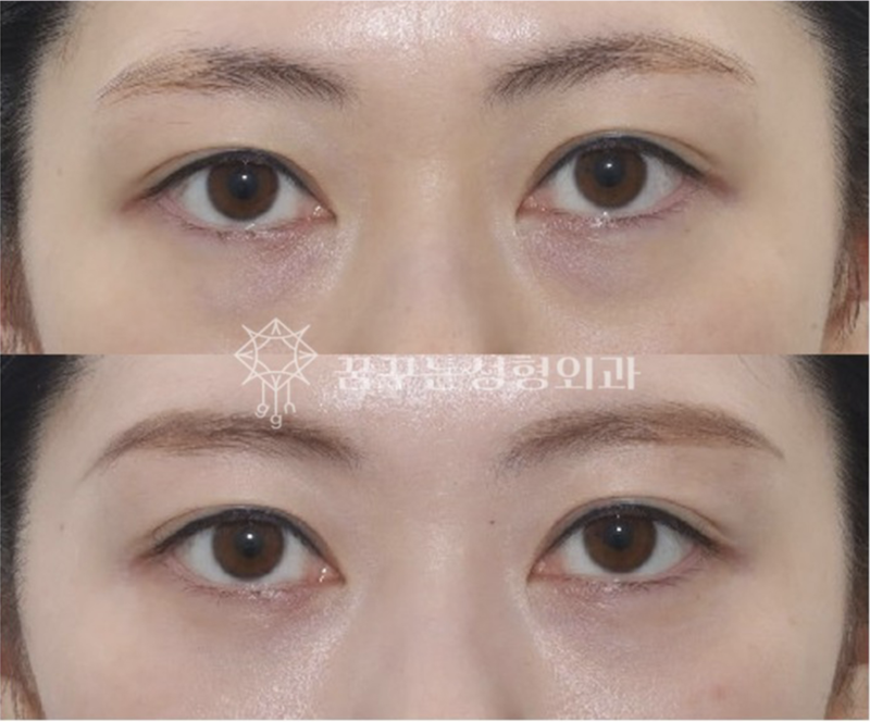 강남역 이마거상 잘하는 병원? 챗GPT에게 물어봤다 사진 16