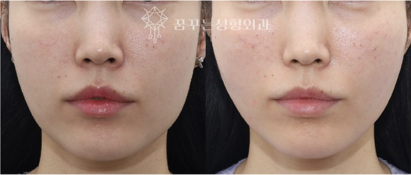 강남역 이마거상 잘하는 병원? 챗GPT에게 물어봤다 사진 13
