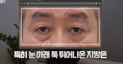우리아빠 10살 어려보이는 중년남성 눈성형의 모든 것 사진 18