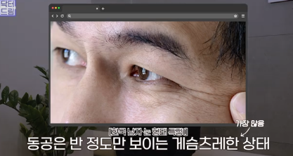 우리아빠 10살 어려보이는 중년남성 눈성형의 모든 것 사진 3