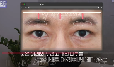 우리아빠 10살 어려보이는 중년남성 눈성형의 모든 것 사진 10