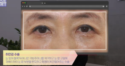 우리아빠 10살 어려보이는 중년남성 눈성형의 모든 것 사진 17