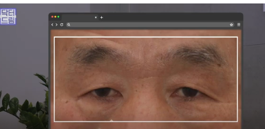 우리아빠 10살 어려보이는 중년남성 눈성형의 모든 것 사진 13