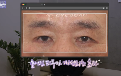우리아빠 10살 어려보이는 중년남성 눈성형의 모든 것 사진 14