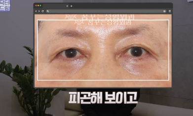 우리아빠 10살 어려보이는 중년남성 눈성형의 모든 것 사진 20