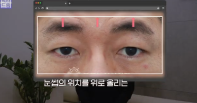 우리아빠 10살 어려보이는 중년남성 눈성형의 모든 것 사진 9