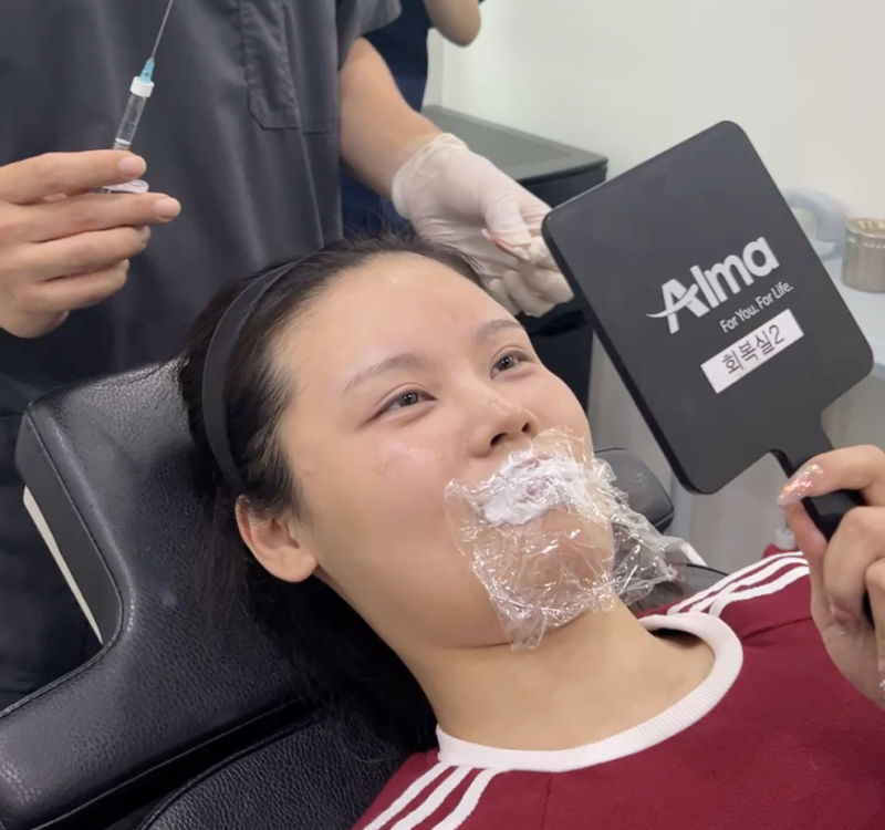 강남역 필러 잘하는 곳 시술 후기, 자연스럽게 올라간 입꼬리와 이마 볼륨으로 동안 만들기 사진 5