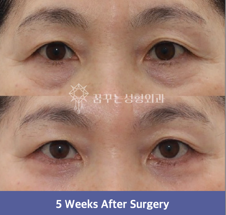 강남역 중년성형, 상안검·하안검 전문“20년은 젊어져요!” 눈성형 전문 성형외과 추천 사진 16