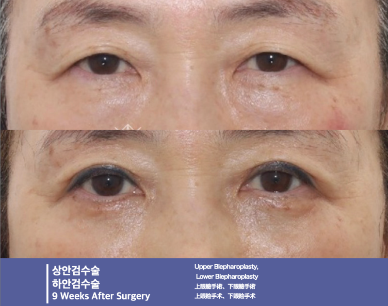 강남역 중년성형, 상안검·하안검 전문“20년은 젊어져요!” 눈성형 전문 성형외과 추천 사진 4