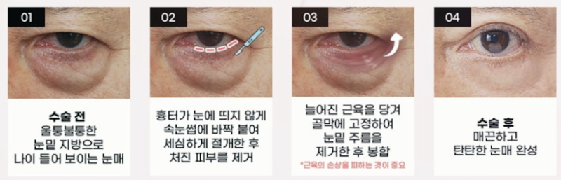 강남역 중년성형, 상안검·하안검 전문“20년은 젊어져요!” 눈성형 전문 성형외과 추천 사진 11