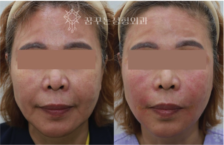 팔자주름 때문에 늙어보여요, 강남역 성형외과 전문의가 답한다 사진 18