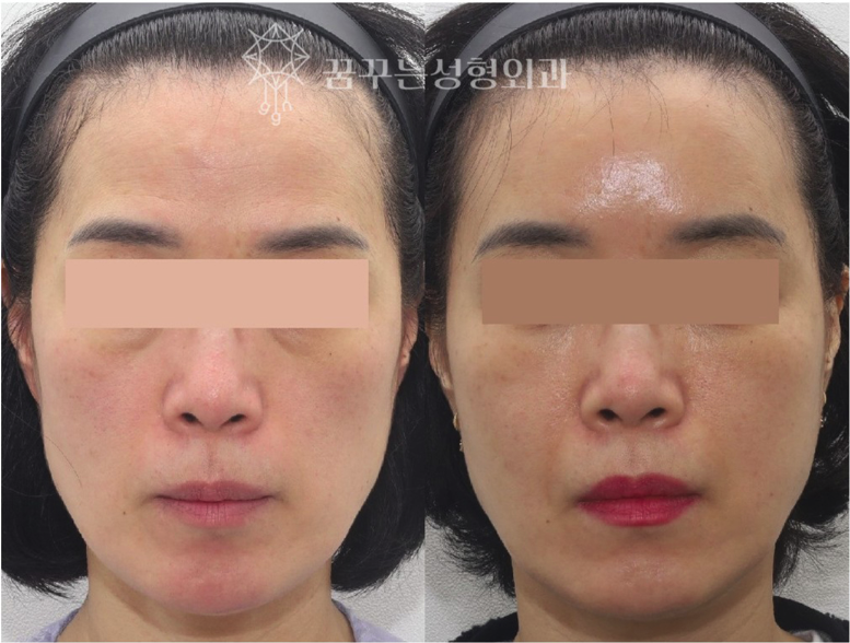 팔자주름 때문에 늙어보여요, 강남역 성형외과 전문의가 답한다 사진 14