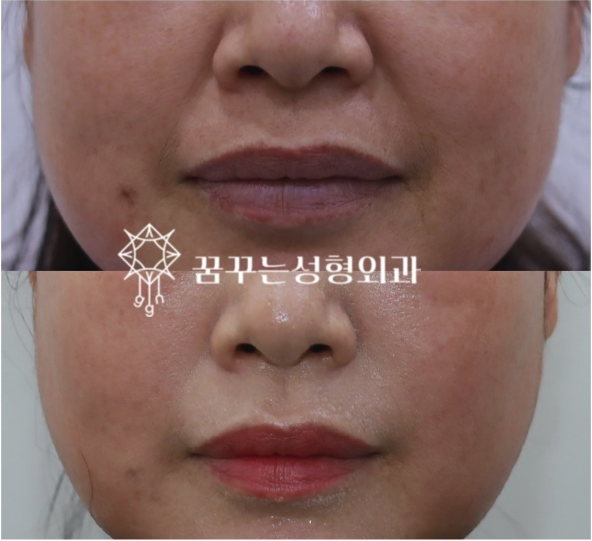 팔자주름 때문에 늙어보여요, 강남역 성형외과 전문의가 답한다 사진 13