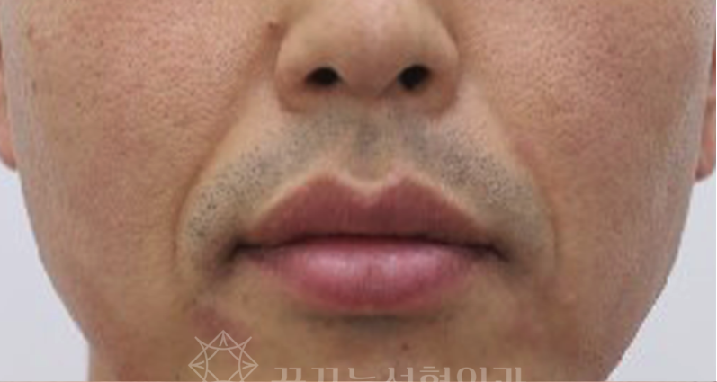 팔자주름 때문에 늙어보여요, 강남역 성형외과 전문의가 답한다 사진 10