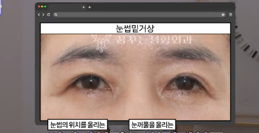 평생 딱 한번만 할 수 있는 수술 사진 19