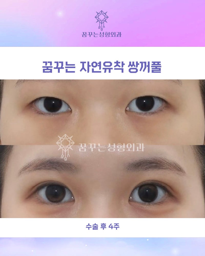 강남역 연예인 쌍꺼풀수술, 내 눈처럼 자연스러운 자연유착쌍꺼풀 사진 15