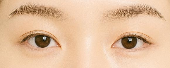 강남역 연예인 쌍꺼풀수술, 내 눈처럼 자연스러운 자연유착쌍꺼풀 사진 7