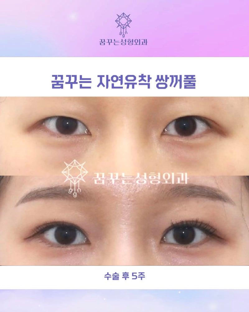 강남역 연예인 쌍꺼풀수술, 내 눈처럼 자연스러운 자연유착쌍꺼풀 사진 17