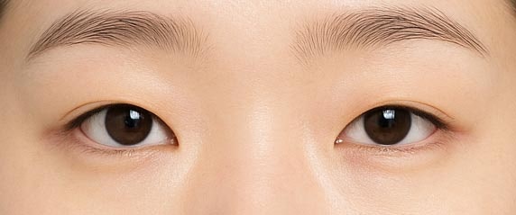 강남역 연예인 쌍꺼풀수술, 내 눈처럼 자연스러운 자연유착쌍꺼풀 사진 13