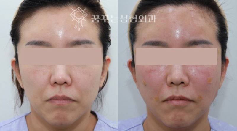 강남역 성형외과전문의, 늙어보이는 팔자주름 어떻게 해결할까?