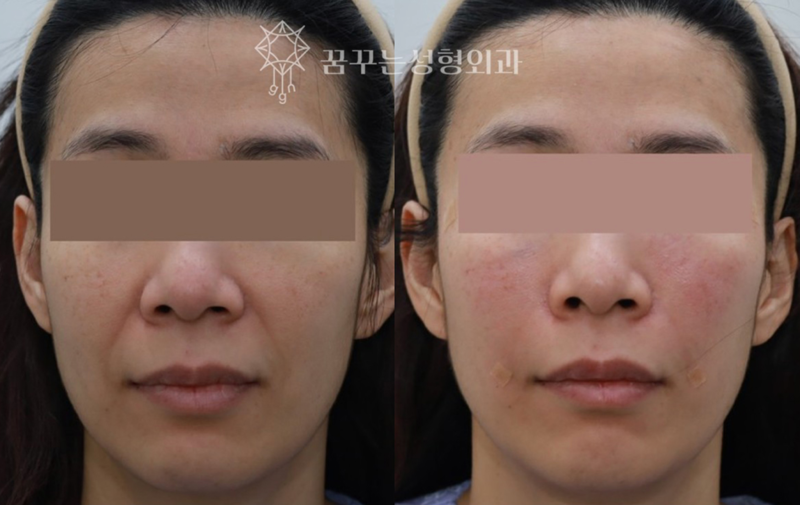 강남역 성형외과전문의, 늙어보이는 팔자주름 어떻게 해결할까? 사진 8
