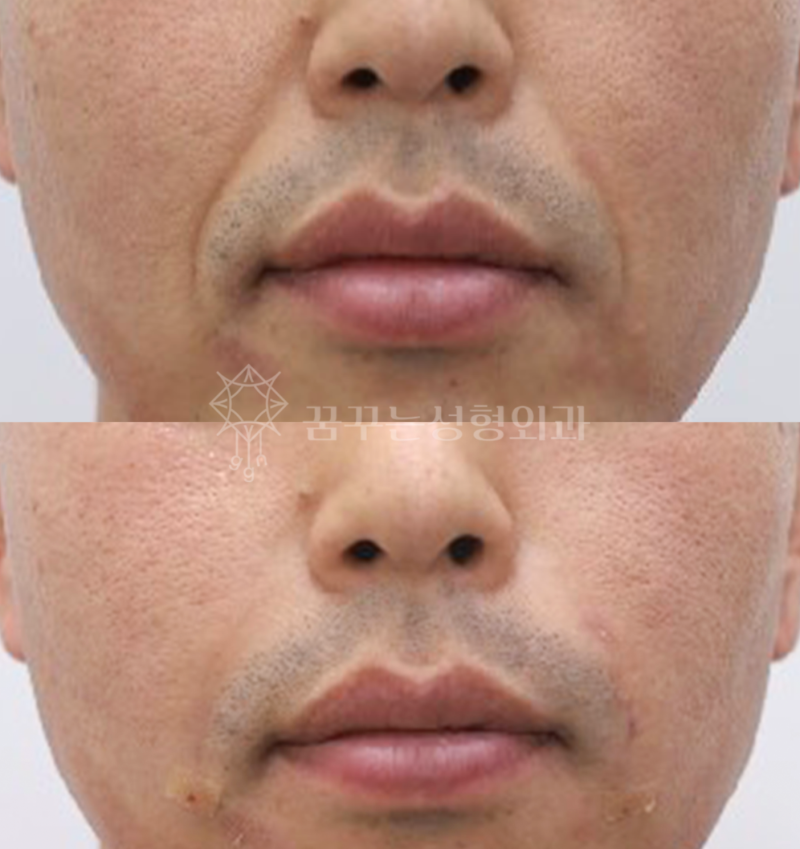 강남역 성형외과전문의, 늙어보이는 팔자주름 어떻게 해결할까? 사진 11